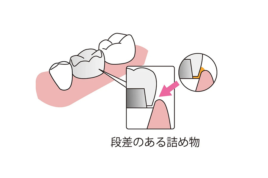 段差詰め物