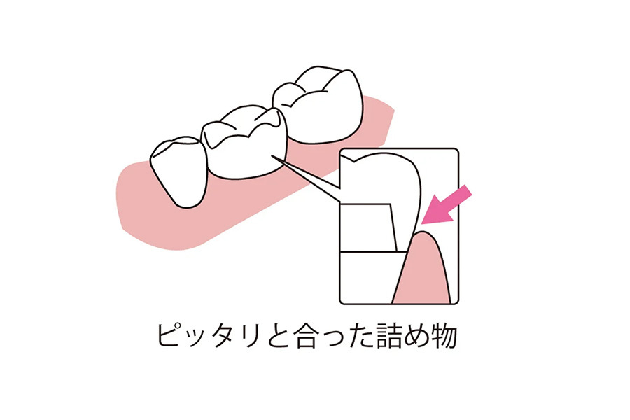 虫歯の再発が少ない