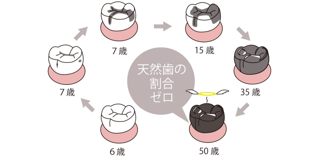 虫歯サイクル