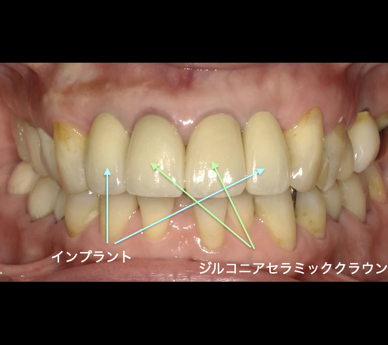 ホワイトスポットbeforeの画像