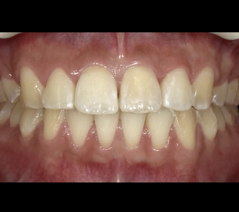 ホワイトスポットafterの画像