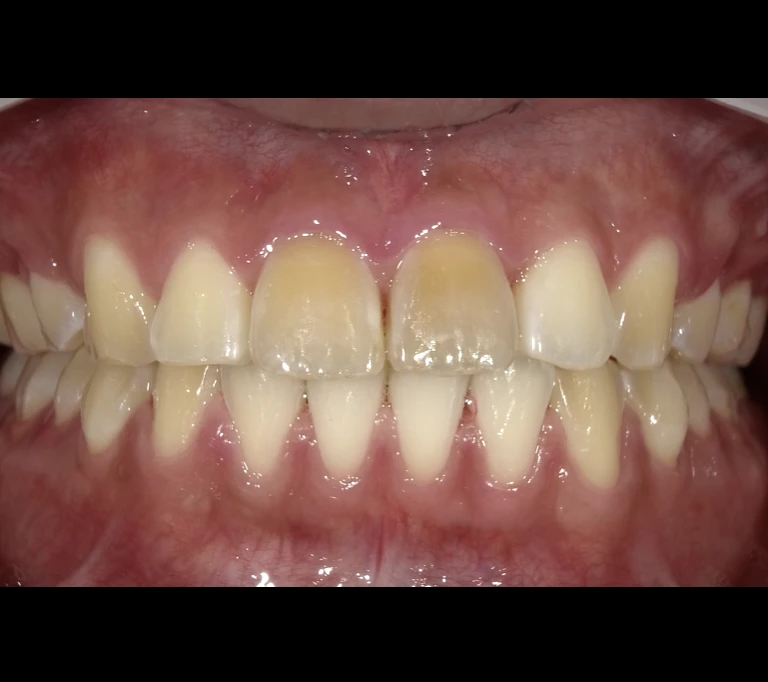 ホワイトスポットbeforeの画像