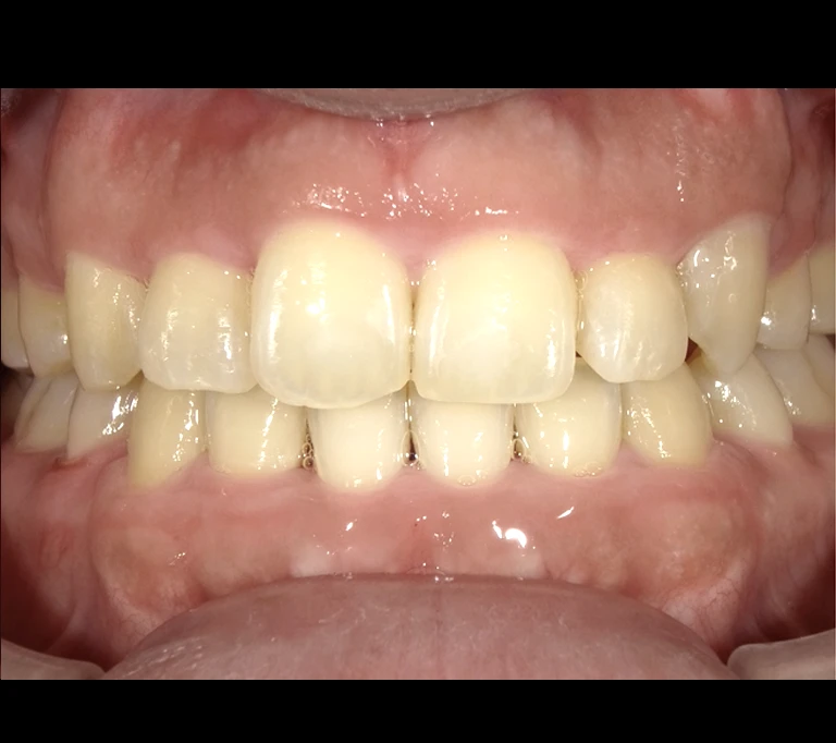 ホワイトスポットafterの画像