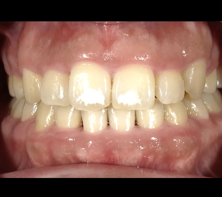 ホワイトスポットbeforeの画像